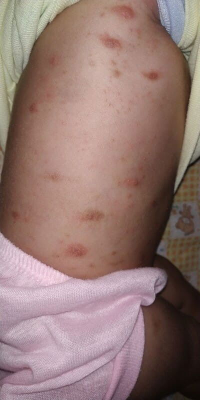 bayi 3 bulan melenting kemerahan