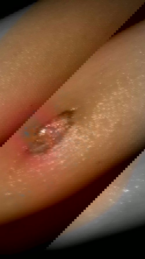 bahayaka bisul pada janin ?