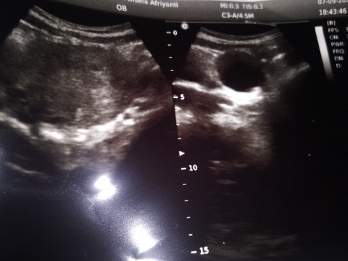 Bun wajar ga si kehamilan jalan 7 minggu baru keliatan kantong janin nya saja makasi