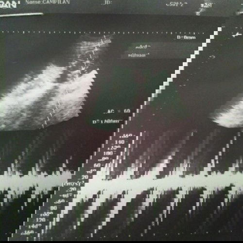 Ano Niya po to ulo diko po Kasi natanong sa ob ko nong kinuha ko ang result