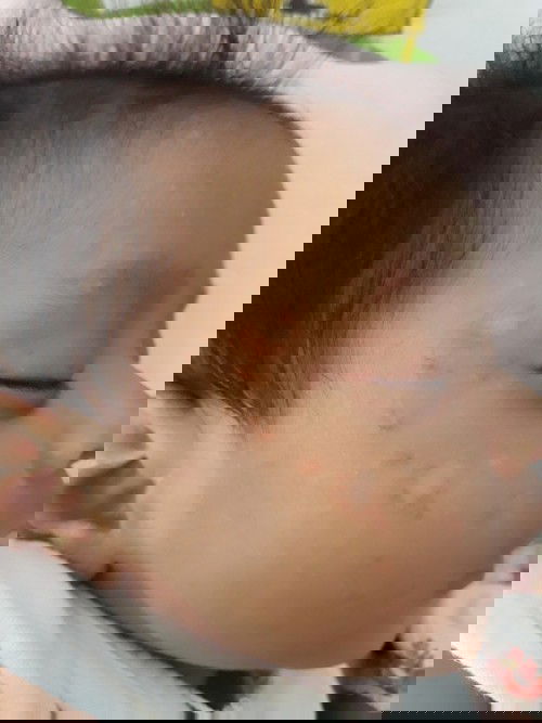 หน้าลูกเป็นแบบนี้ใช่ยาอะไรทาดีค่ะ แม่กลุ้มใจมากเลย