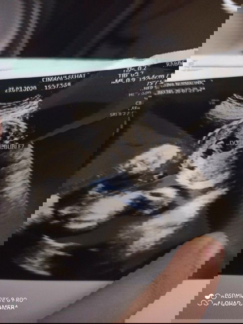 Double bubble pada bayi ku sehingga harus lahiran secar