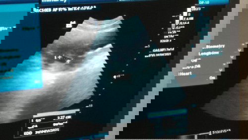 Janin disebelah kanan