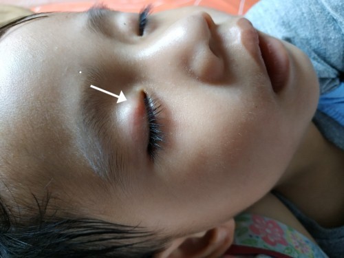 benjolan pada mata anak