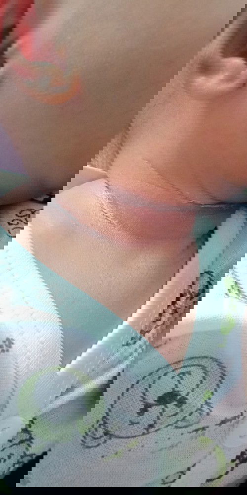 LECET PADA LEHER BAYI