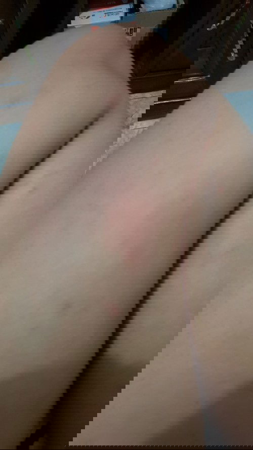 Gatal-gatal kaki & tangan