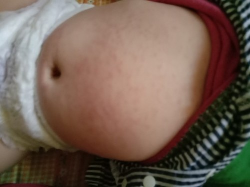 Hai,anak Sya baru sembuh dri demam kemudian timbul ruam d dada,belakang, n muka.tpi anak tetap aktif