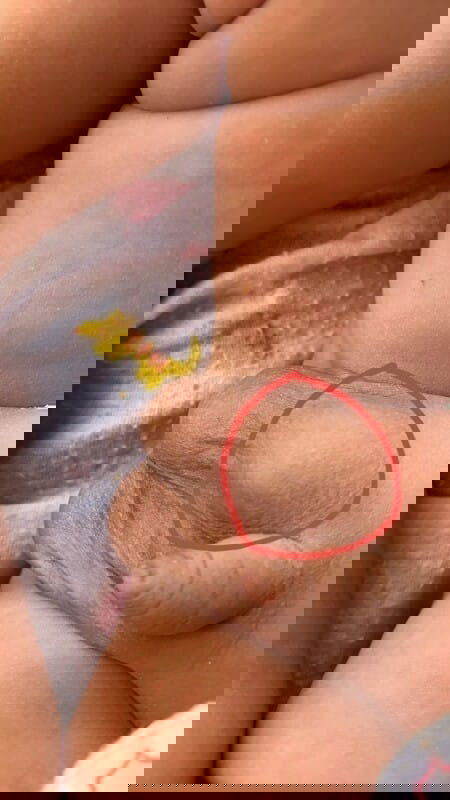 ทารกไส้เลื่อนจากการเบ่ง