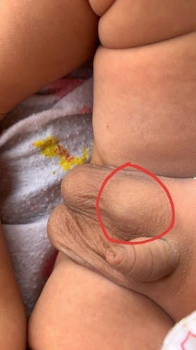 ทารกไส้เลื่อนจากการเบ่ง