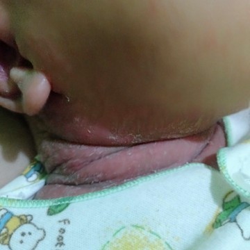 Bruntusan di leher dan kepala siku tan ketiak