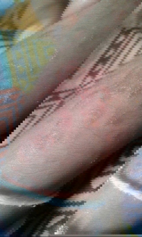 merah merah mngelupas