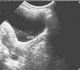 mang thai ngoài tử cung