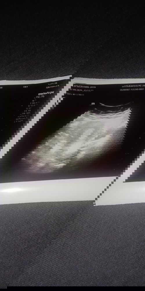 salam semua..hari isnin 7hrbln saya ada scan..doktor ckp tu gumpalan darah..nk tgk ia lekat kt rahim