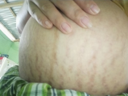 Stretch Marks