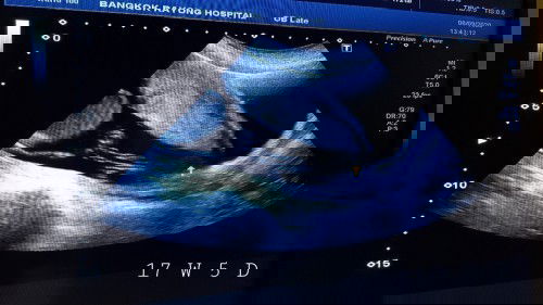 ใครเคยมีภาวะรกต่ำบ้าง น่าเป็นห่วงไหมค่ะ ?