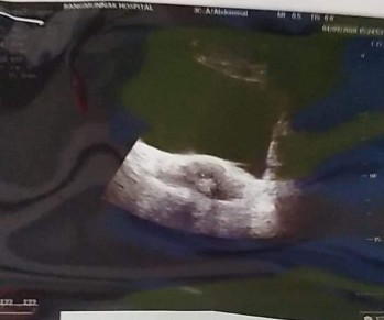 อยากทราบว่านี้กี่Wค่ะท้องไม่รู้ตัวค่ะท้องที่4เคยแท้ง3แท้งตอน8wนั่นก้อไม่รัว่าท้องค่ะ