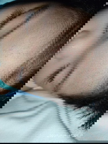 Rashes sa noo, leeg at likod