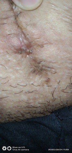 ???? Cs scar