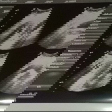 Hasil USG 6 minggu masih berupa kantong terus 2 minggu disuruh kembali lagi tpi klau ngeflek disuruh