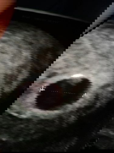 ท้องได้9วีคแต่ซาวด์ไม่เห็นตัวเด็กมีใครเคยเจอแฉบบนี้ไหมคะมีเลือดออกเมื่อวันอังคารสีน้ำตาลมาวัน