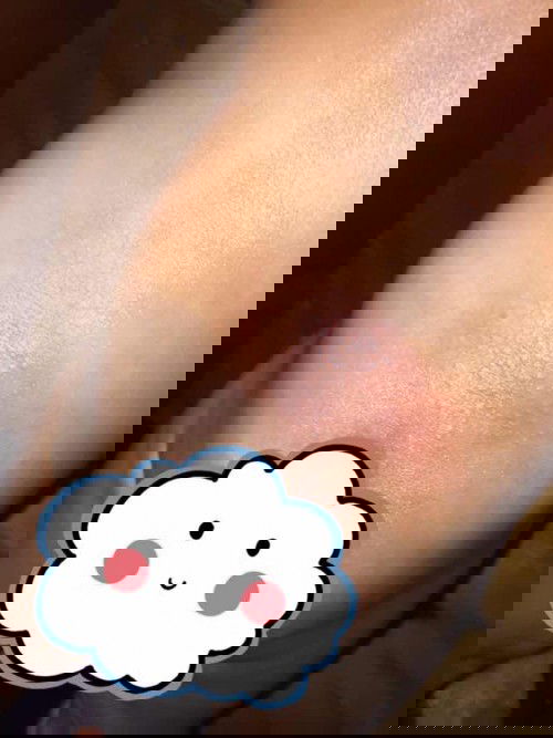 มีผื่นแดงเป็นจ้ำๆขึ้นช่วงก้น