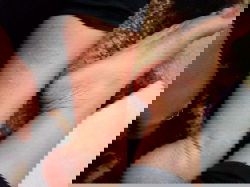 Biduran yg berbulan bulan gak brenti