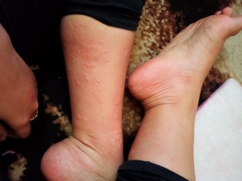 Biduran yg berbulan bulan gak brenti