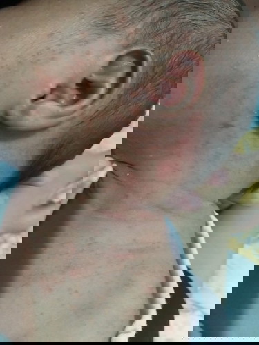 Rashes