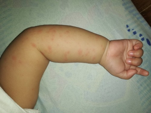 Bungang araw po ba ito?