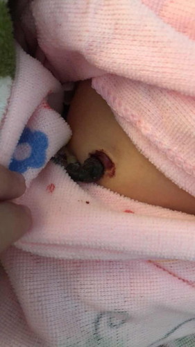 สะดือ6วันเหมือนจะหลุด