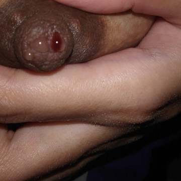Breast blood