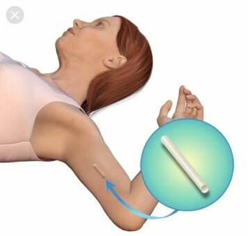 CONTRACEPTIVE IMPLANT