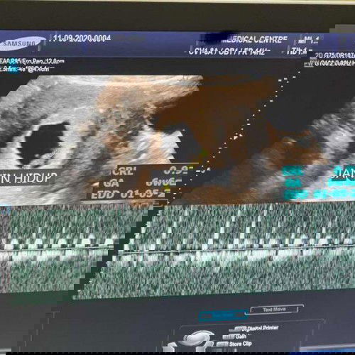 GA berbeda antara USG dan HPHT