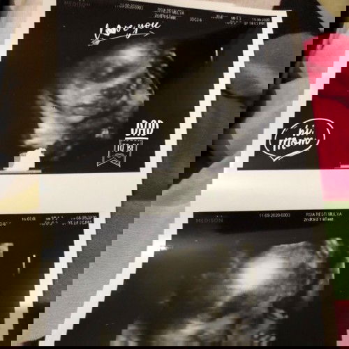 USG Dede bayi yg aktif