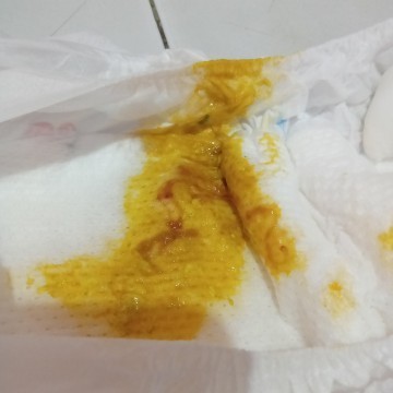May dugo sa dumi ni baby