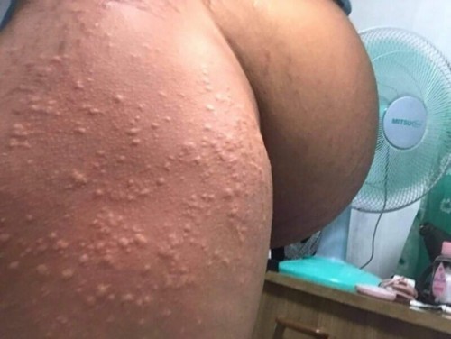 Puppp rash po ba ito?