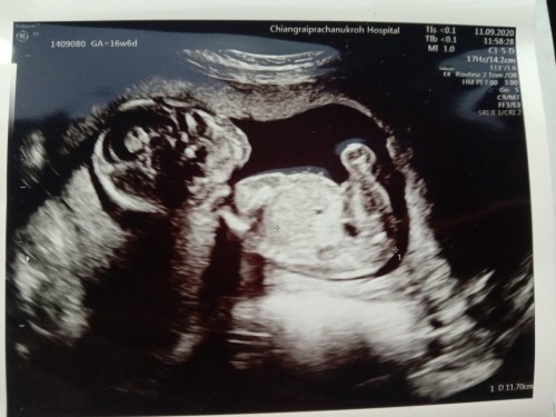 16w6d ลูกสาว