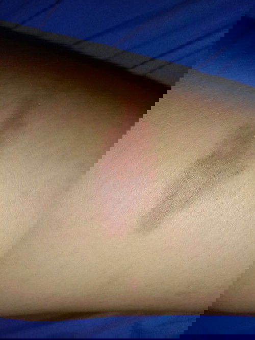 มีแม่ๆทานไหนเคยเป็นแบบนี้ไหมค่ะอยู่ดีๆก็เป็นแบบนี้จากเดิมขึ้นแค่จุดแดงๆเล็กๆคันๆบ้างยิ่งเกายิ่งคัน