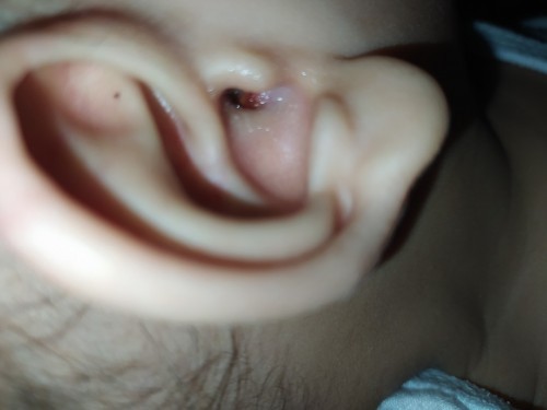 Bump inside ear