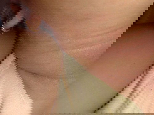 MERAH DAN LECET DISEKITAR LEHER DAN BELAKANG TELINGA