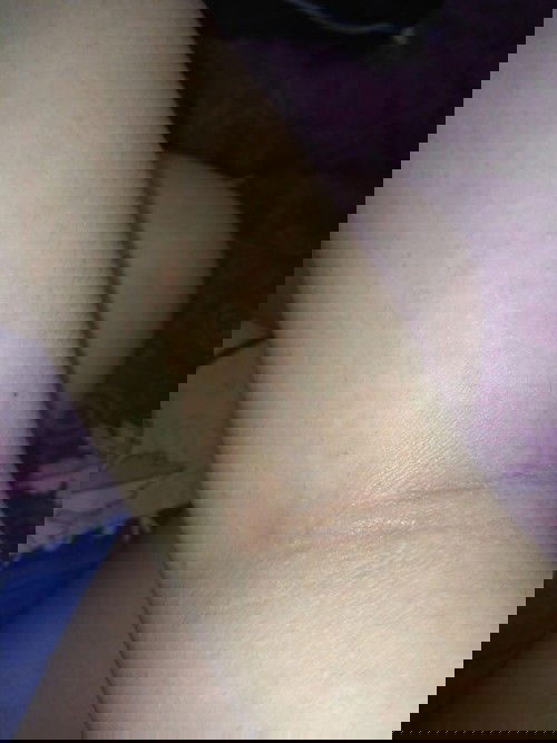 Adakah Yg Pernah Biduran Saat Hamil? Bagaimana Solusi Nya?