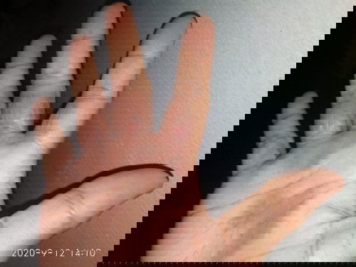 gatal tak kunjung smbuh