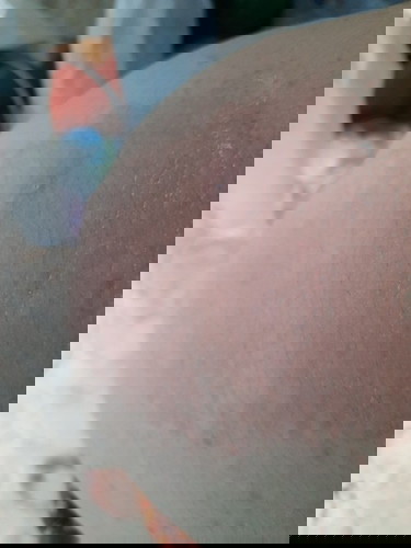 อาการแบบนี้มีใครเป็นบ้างคะ คัน มากเลยค่ะ เป็นผื่นคันทั่วตัวเลย