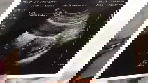 6minggu sudah terlihat janin