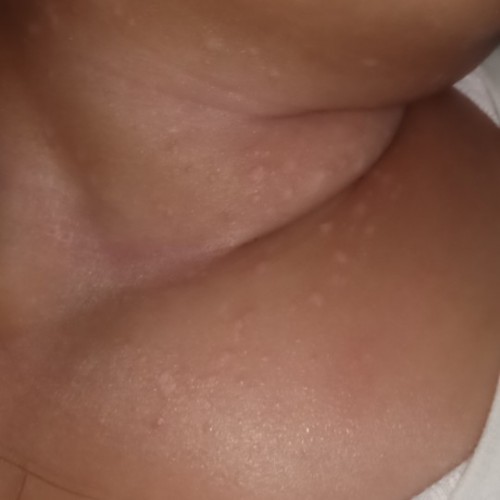 Leher muncul bintik putih