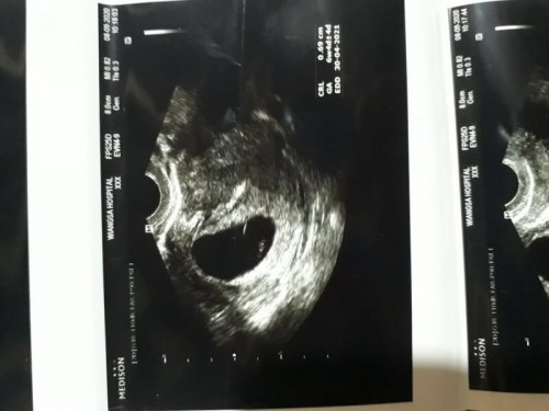 เสี่ยงท้องลม