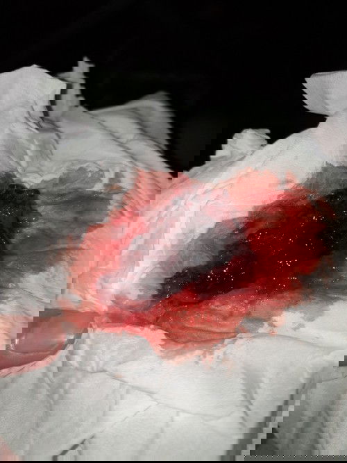 ก้อนเลือดหลังคลอด