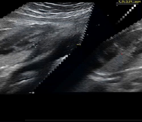 ซาวด์เจอถุงน้ำบริเวณเยื่อหุ้มหัวใจลูก