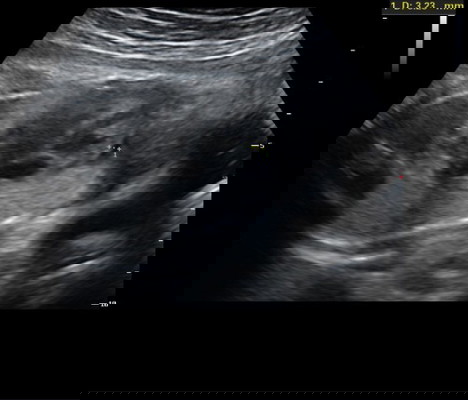 ซาวด์เจอถุงน้ำบริเวณเยื่อหุ้มหัวใจลูก