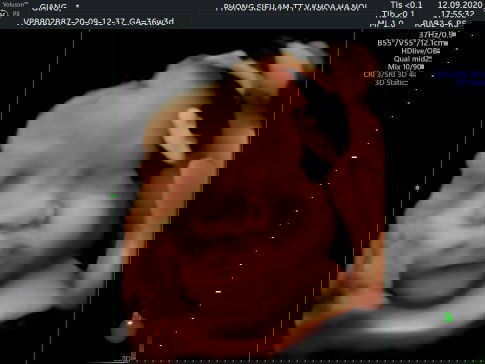 Lo lắng phải mổ